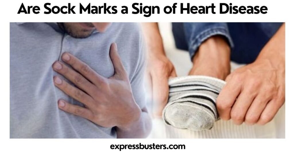 Are Sock Marks a Sign of Heart Disease
